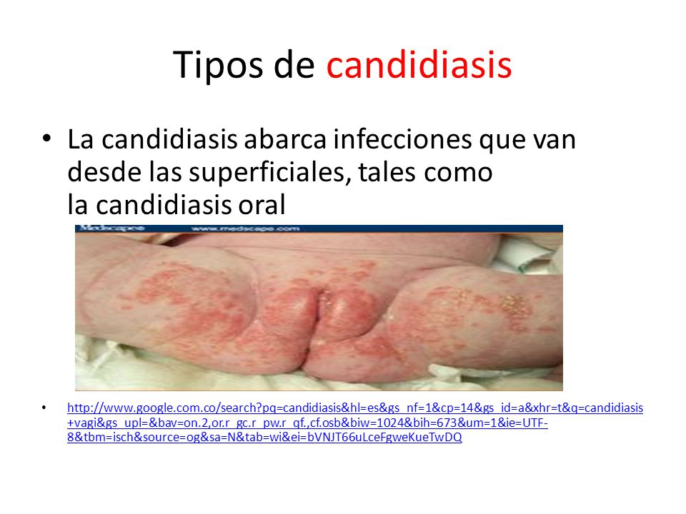 tipos de candida oral